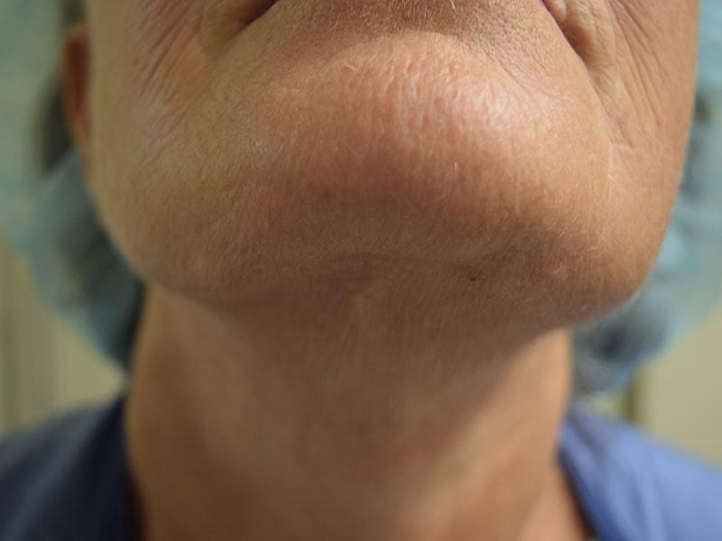Meghan Nadeau, MD scar treatment after — Seattle, WA