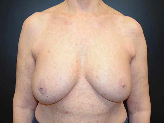 Breast Reduction before at Meghan Nadeau, MD in Seattle, WA