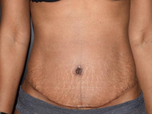 Mini Tummy Tuck after at Meghan Nadeau, MD in Seattle, WA