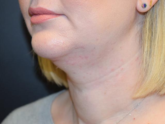 Neck Liposuction after at Meghan Nadeau, MD in Seattle, WA