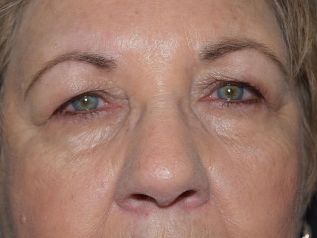 Brow Lift before at Meghan Nadeau, MD in Seattle, WA