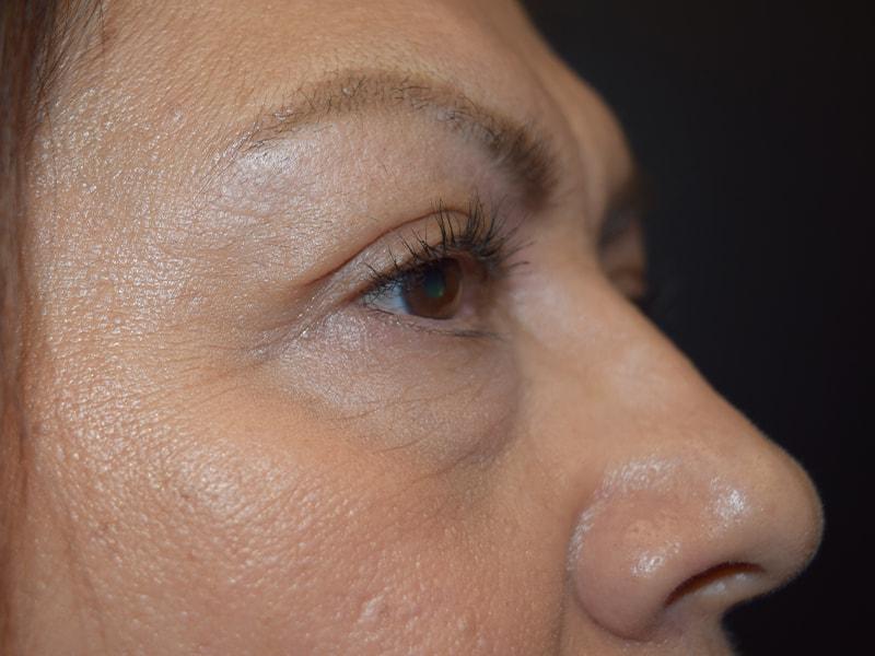 Meghan Nadeau, MD eyelid lift after — Seattle, WA