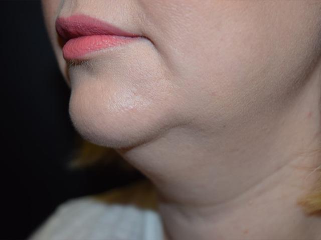 Neck Liposuction before at Meghan Nadeau, MD in Seattle, WA