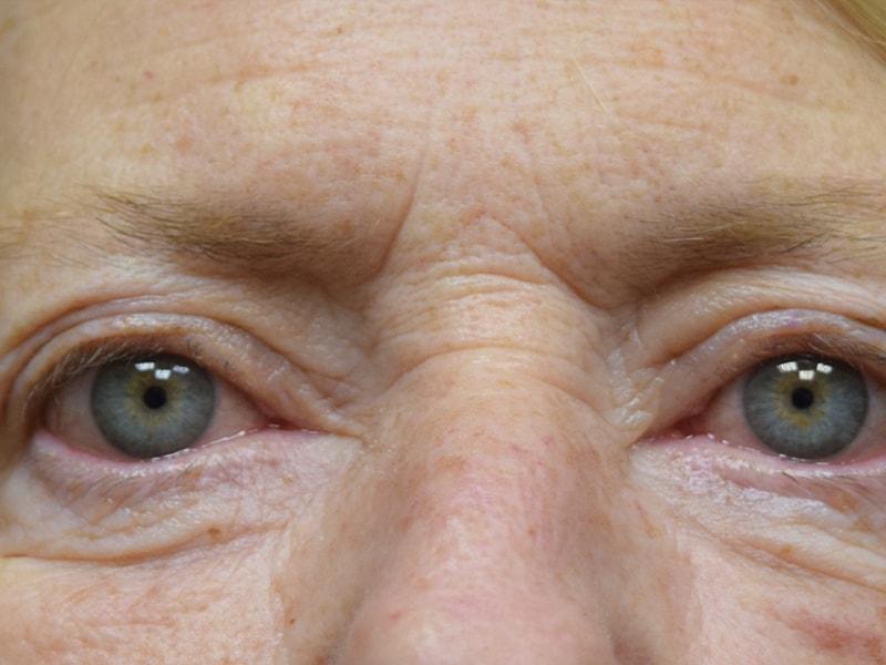 Meghan Nadeau, MD eyelid lift after — Seattle, WA