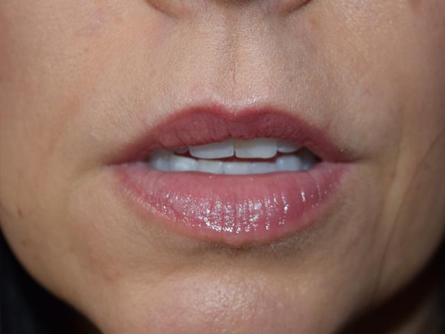 Dermal Fillers before at Meghan Nadeau, MD in Seattle, WA