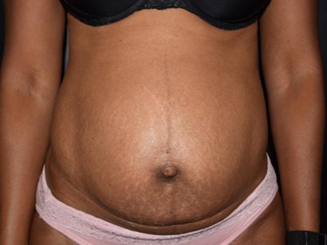 Mini Tummy Tuck before at Meghan Nadeau, MD in Seattle, WA