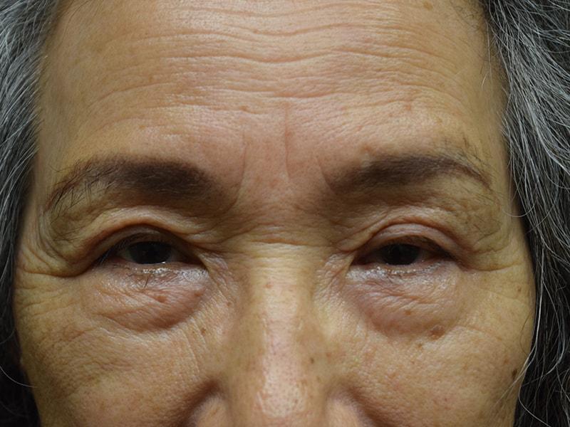 Meghan Nadeau, MD eyelid lift after — Seattle, WA
