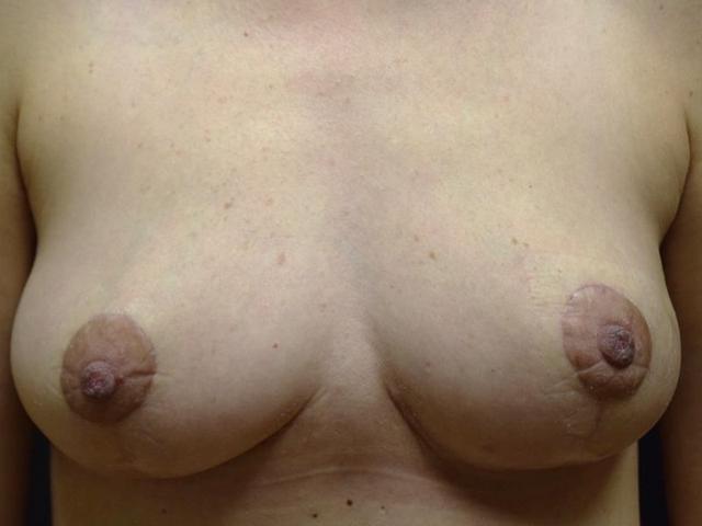 Breast Lift after at Meghan Nadeau, MD in Seattle, WA