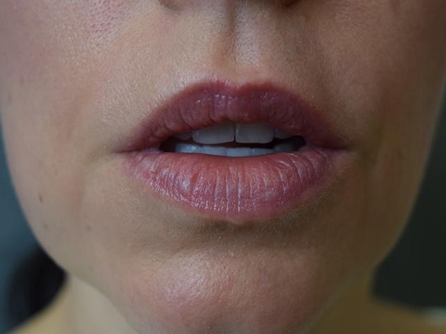 Dermal Fillers after at Meghan Nadeau, MD in Seattle, WA