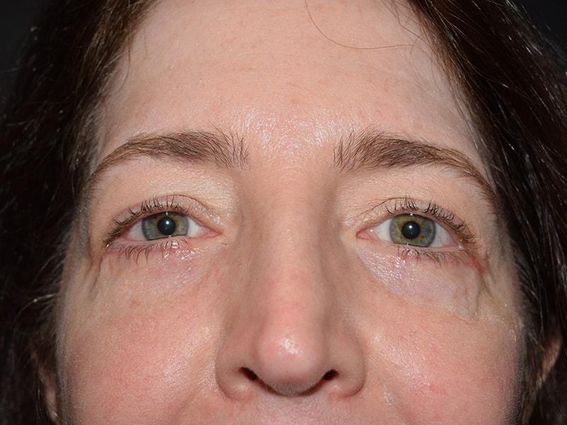 Meghan Nadeau, MD eyelid lift after — Seattle, WA