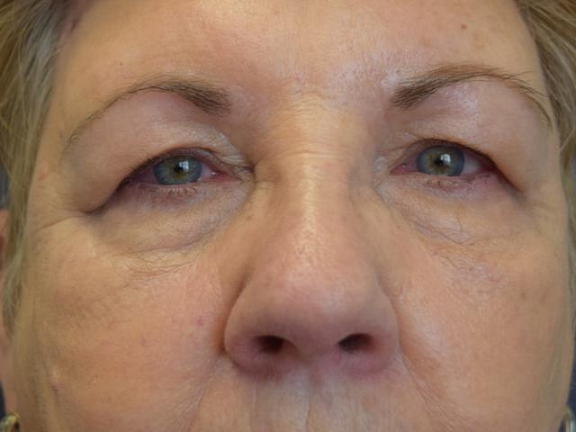 Brow Lift after at Meghan Nadeau, MD in Seattle, WA