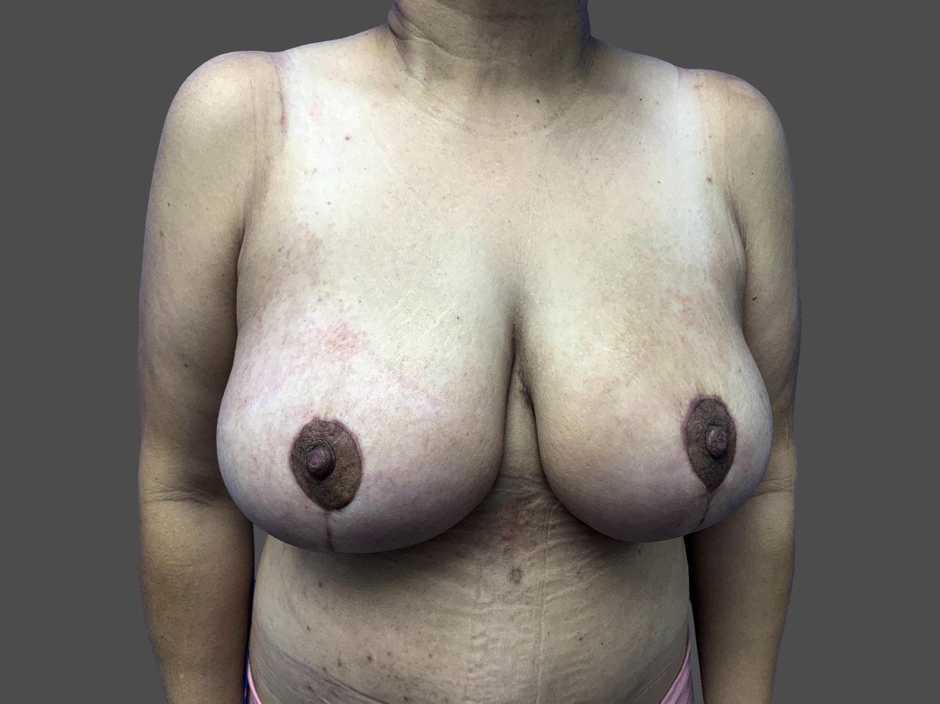 Kadz Plastic Surgery breast lift after — Beverly Hills, CA