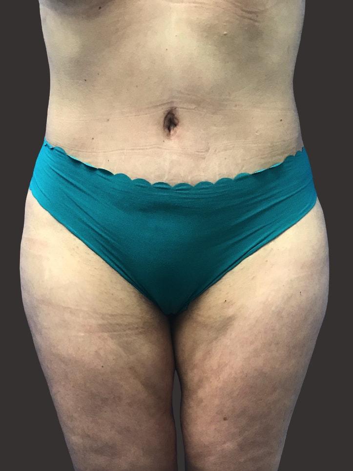 Kadz Plastic Surgery tummy tuck after — Beverly Hills, CA