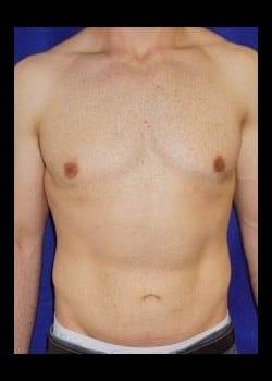 Daniel A. Medalie, M.D.- Cleveland Plastic Surgery gynecomastia after — Beachwood, OH