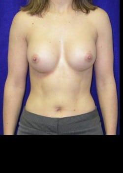 Daniel A. Medalie, M.D.- Cleveland Plastic Surgery tummy tuck after — Beachwood, OH