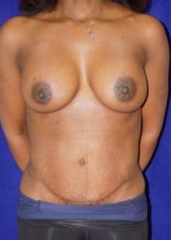 Mini Tummy Tuck after at Daniel A. Medalie, M.D.- Cleveland Plastic Surgery in Beachwood, OH