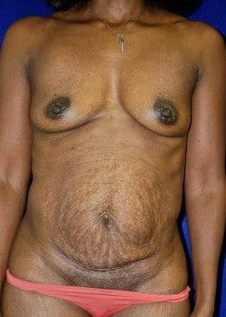 Mini Tummy Tuck before at Daniel A. Medalie, M.D.- Cleveland Plastic Surgery in Beachwood, OH