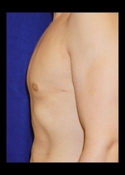 Daniel A. Medalie, M.D.- Cleveland Plastic Surgery gynecomastia after — Beachwood, OH
