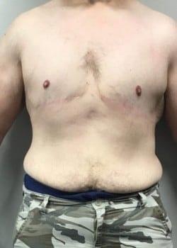 Daniel A. Medalie, M.D.- Cleveland Plastic Surgery gynecomastia after — Beachwood, OH