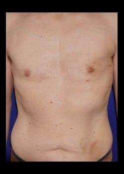 Daniel A. Medalie, M.D.- Cleveland Plastic Surgery gynecomastia after — Beachwood, OH