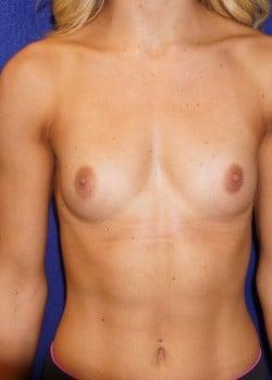 Tummy Tuck before at Daniel A. Medalie, M.D.- Cleveland Plastic Surgery in Beachwood, OH