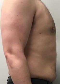 Daniel A. Medalie, M.D.- Cleveland Plastic Surgery gynecomastia after — Beachwood, OH