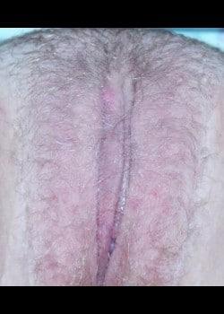 Daniel A. Medalie, M.D.- Cleveland Plastic Surgery tummy tuck after — Beachwood, OH