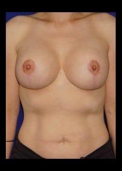 Breast Lift after at Daniel A. Medalie, M.D.- Cleveland Plastic Surgery in Beachwood, OH