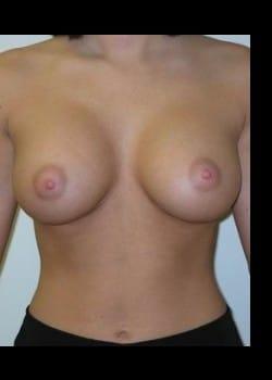 Daniel A. Medalie, M.D.- Cleveland Plastic Surgery tummy tuck after — Beachwood, OH