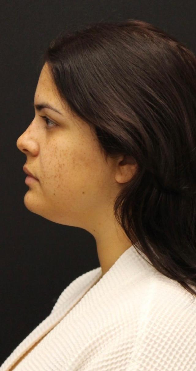 Neck Lift before at Aeris Plastic Surgery in Coral Gables, FL