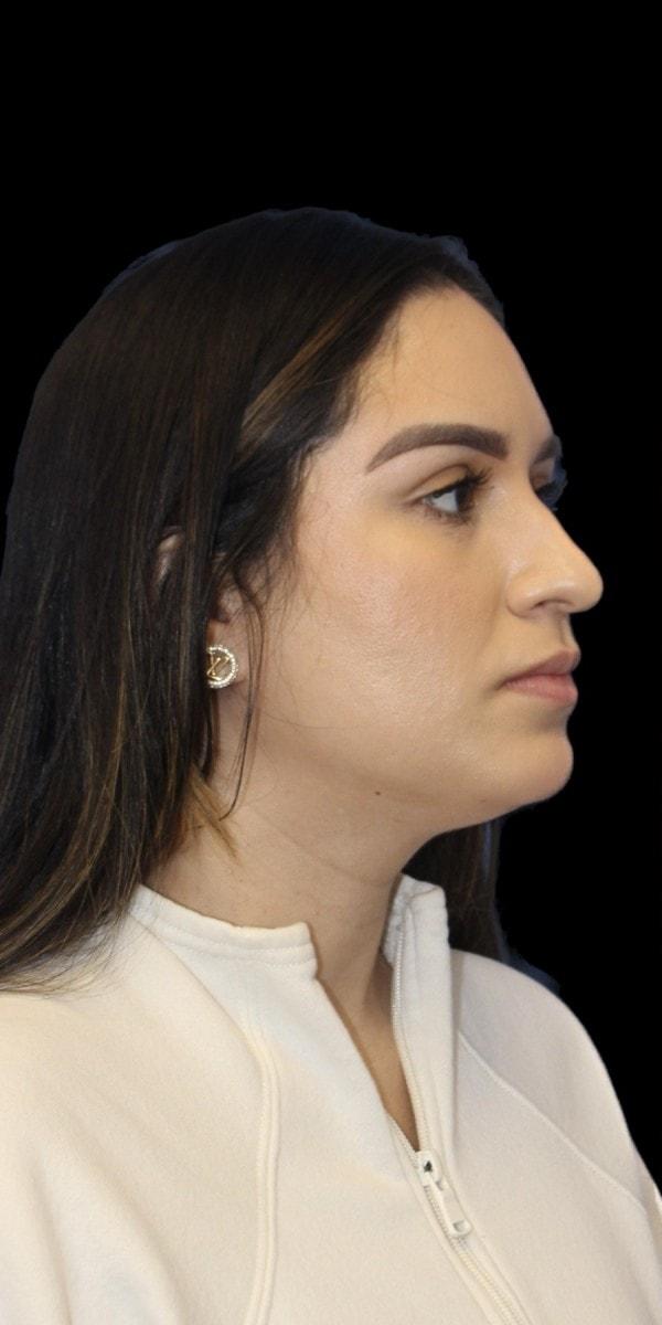 Rhinoplasty before at Aeris Plastic Surgery in Coral Gables, FL