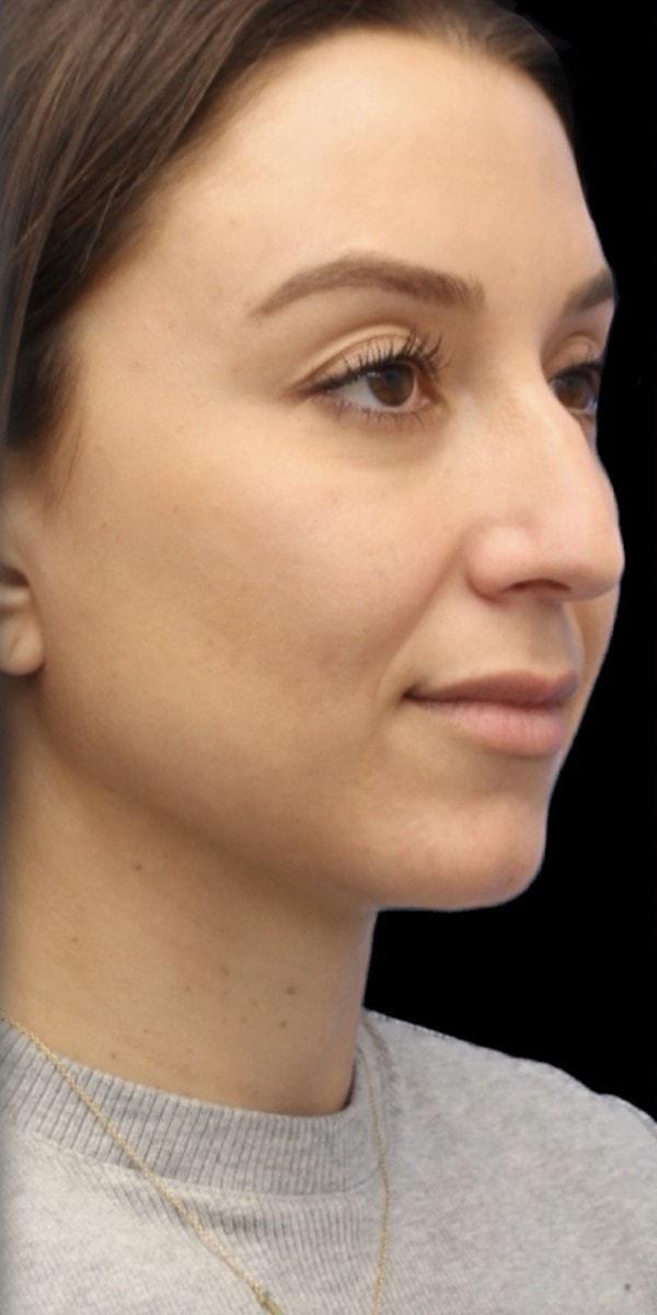 Rhinoplasty before at Aeris Plastic Surgery in Coral Gables, FL
