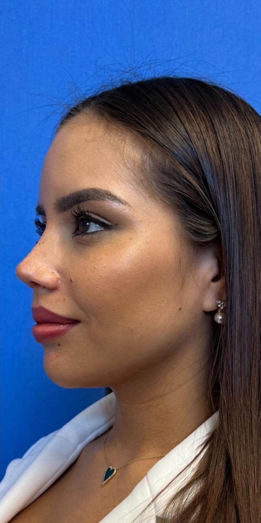 Aeris Plastic Surgery rhinoplasty after — Miami, FL