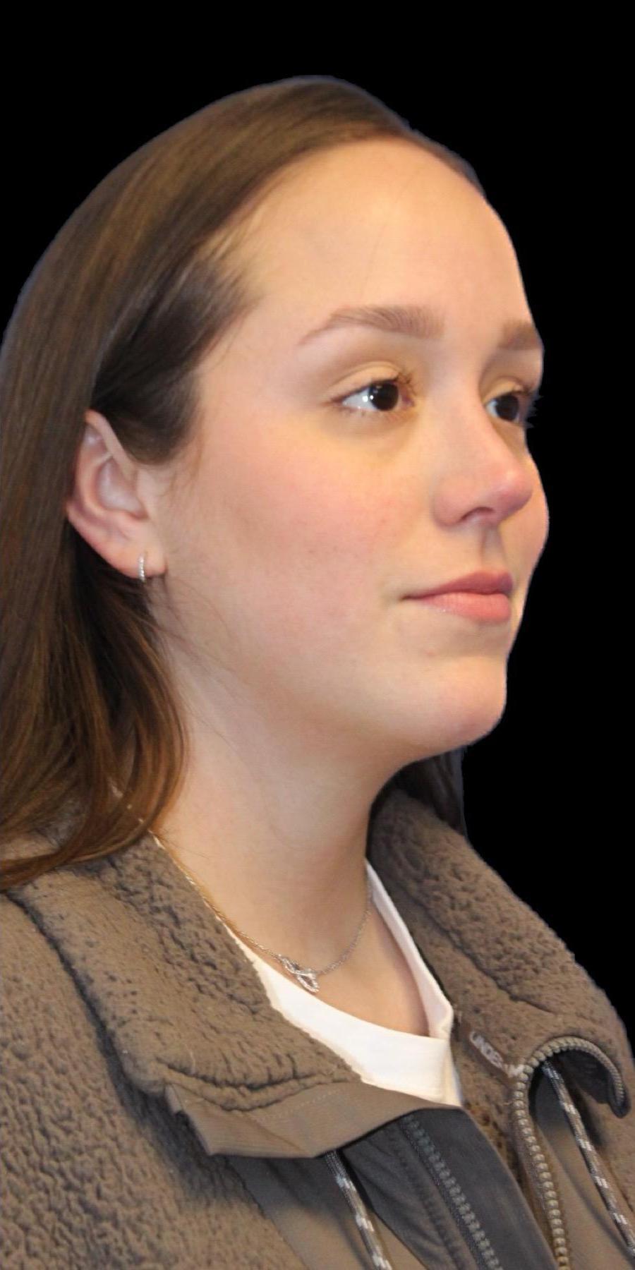 Aeris Plastic Surgery rhinoplasty after — Miami, FL