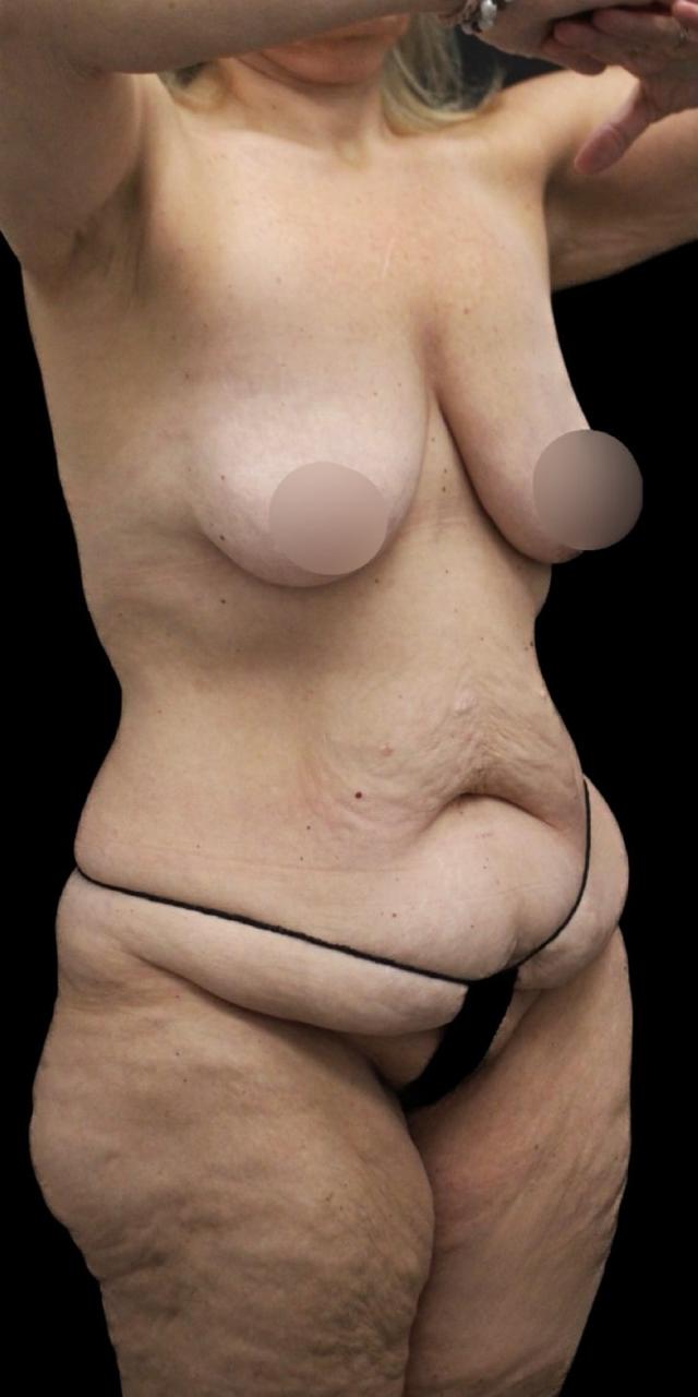 Mommy Makeover before at Aeris Plastic Surgery in Coral Gables, FL