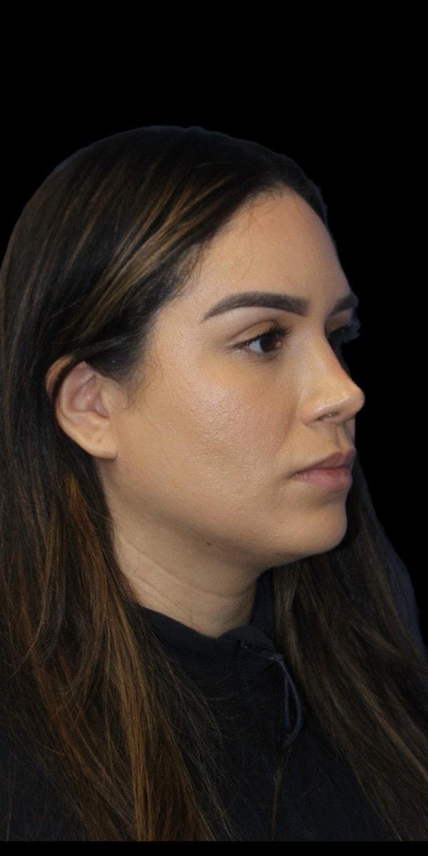 Rhinoplasty after at Aeris Plastic Surgery in Coral Gables, FL