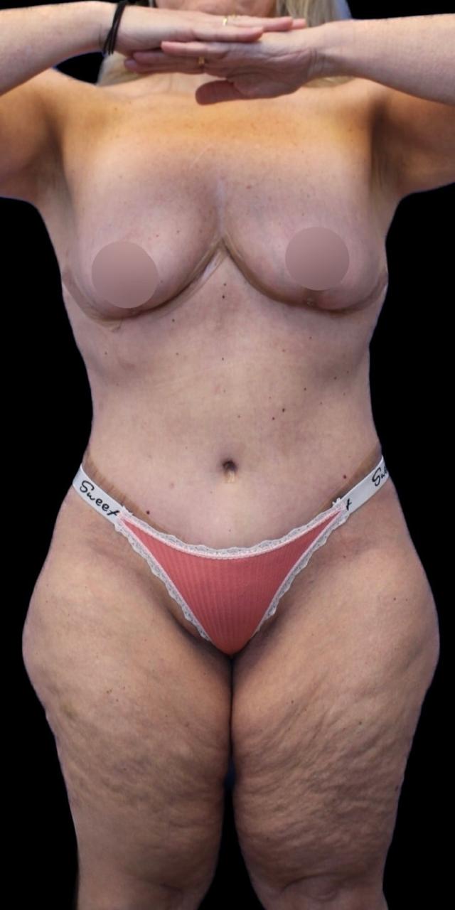 Mommy Makeover after at Aeris Plastic Surgery in Coral Gables, FL