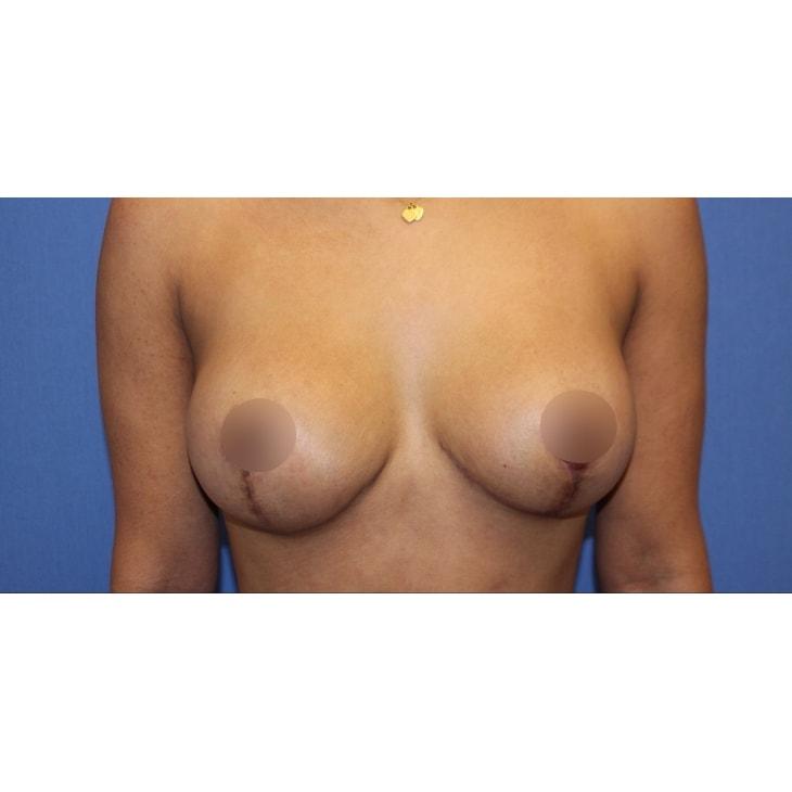 Aeris Plastic Surgery breast lift after — Coral Gables, FL