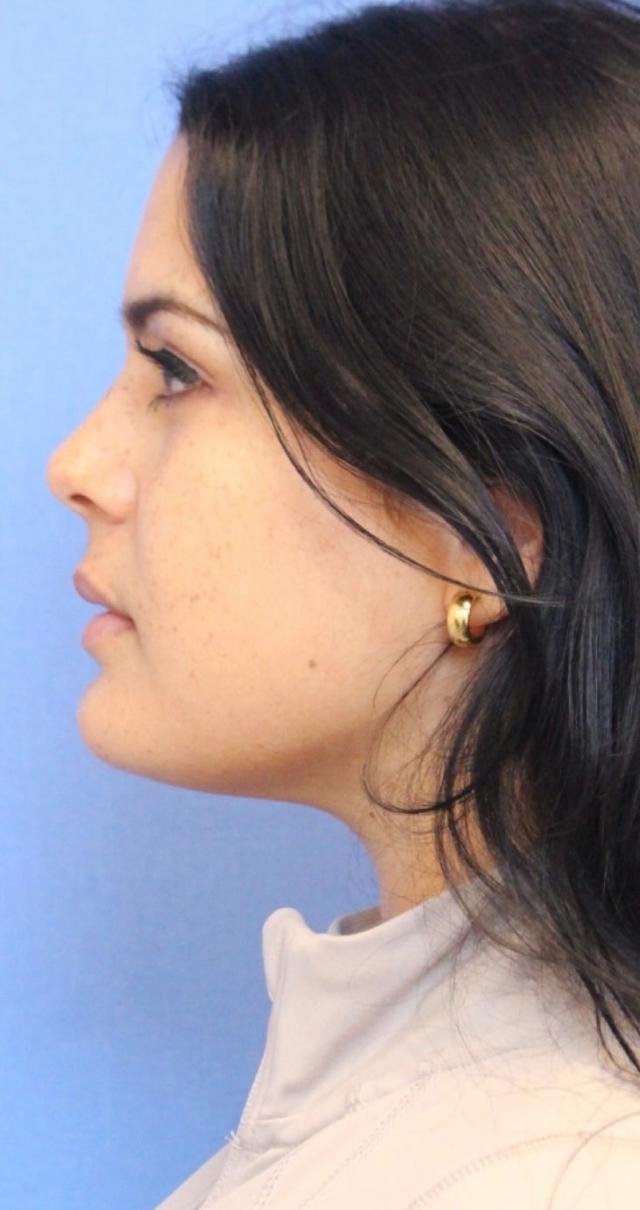 Neck Lift after at Aeris Plastic Surgery in Coral Gables, FL
