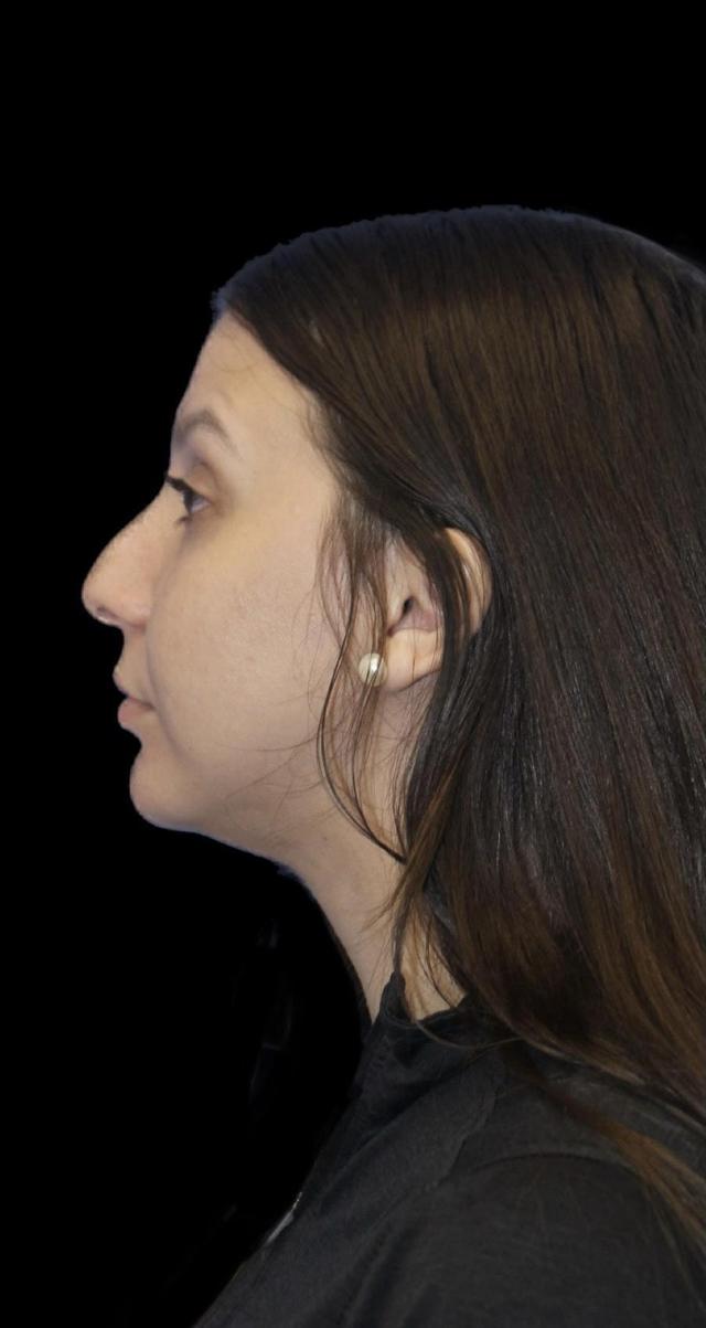 Rhinoplasty before at Aeris Plastic Surgery in Coral Gables, FL