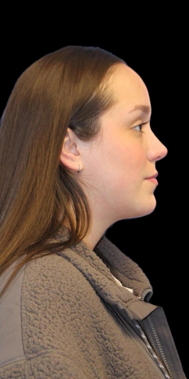 Rhinoplasty after at Aeris Plastic Surgery in Miami, FL