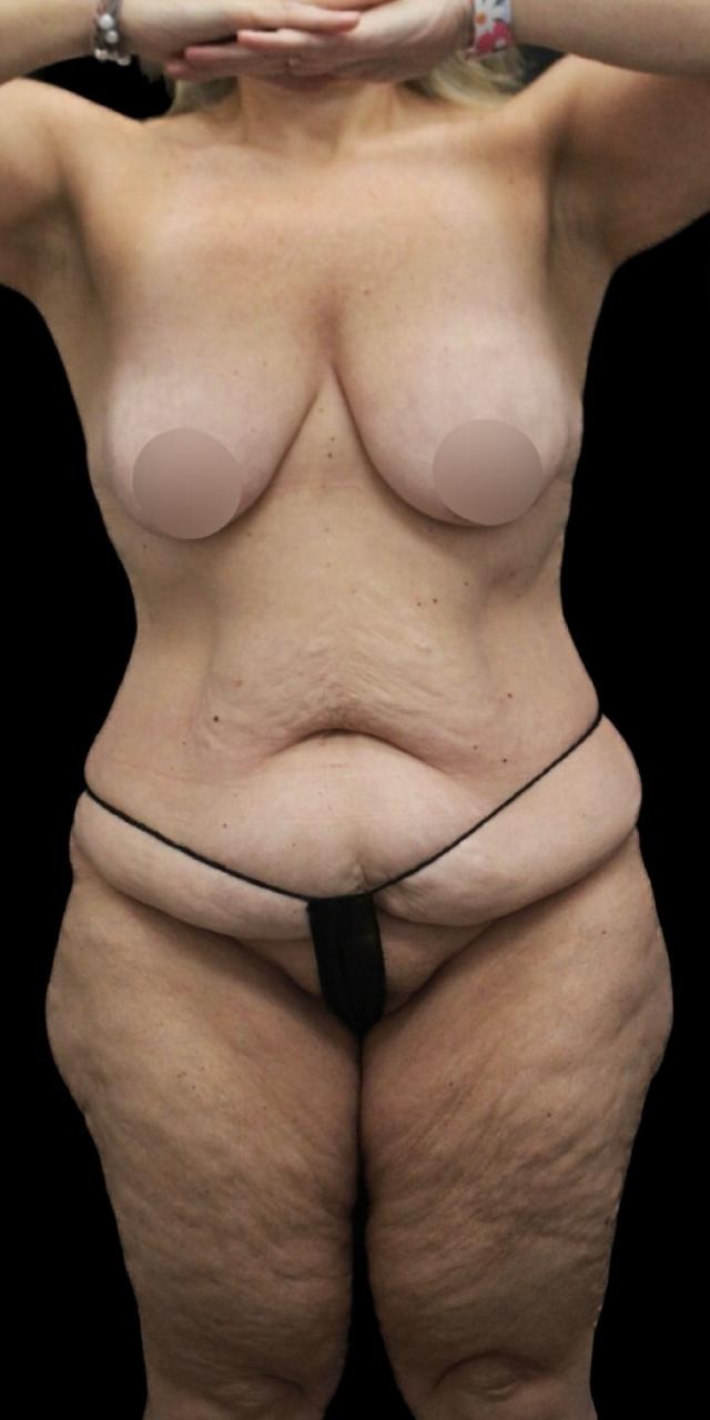 Mommy Makeover before at Aeris Plastic Surgery in Coral Gables, FL