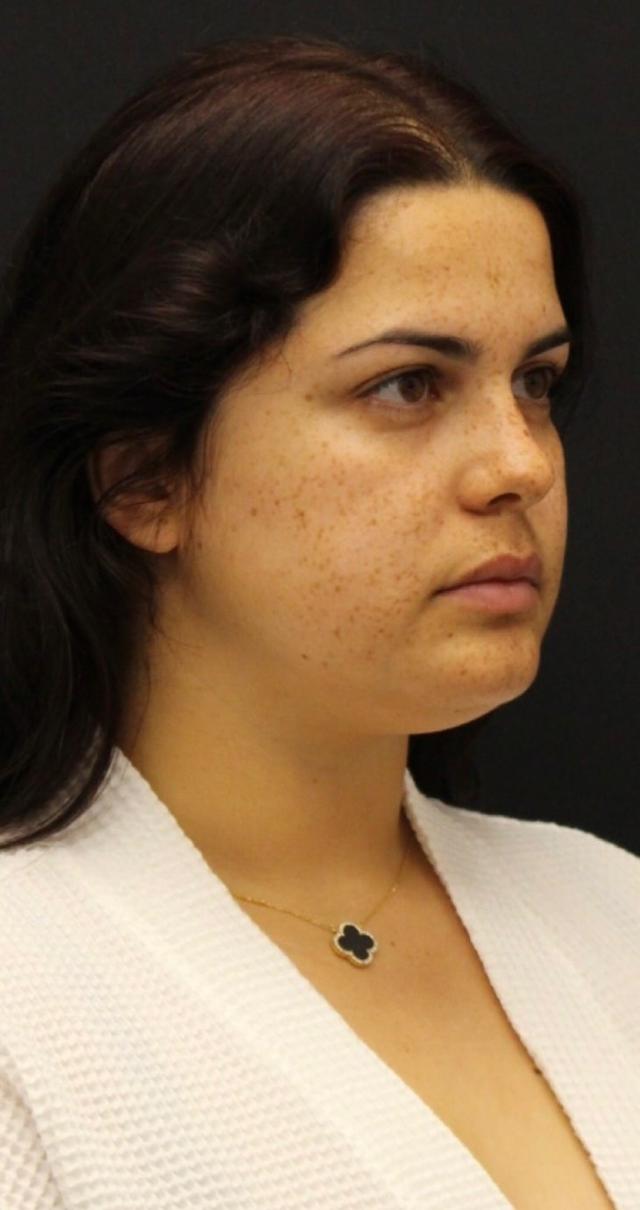 Neck Lift before at Aeris Plastic Surgery in Coral Gables, FL
