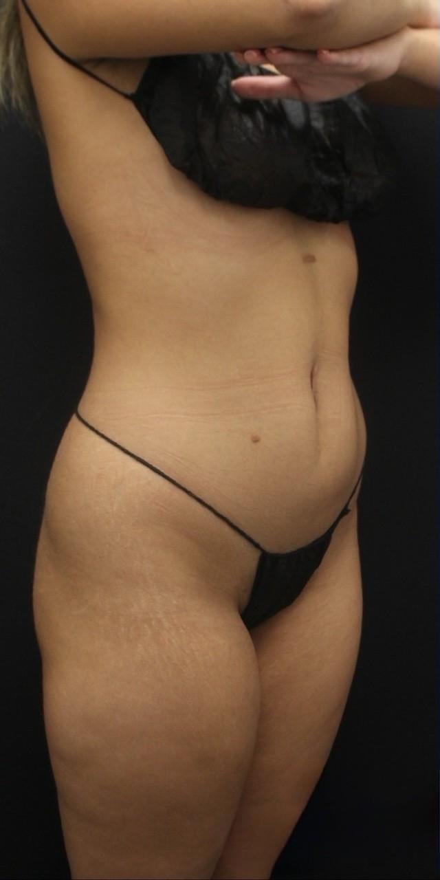 Liposuction before at Aeris Plastic Surgery in Coral Gables, FL