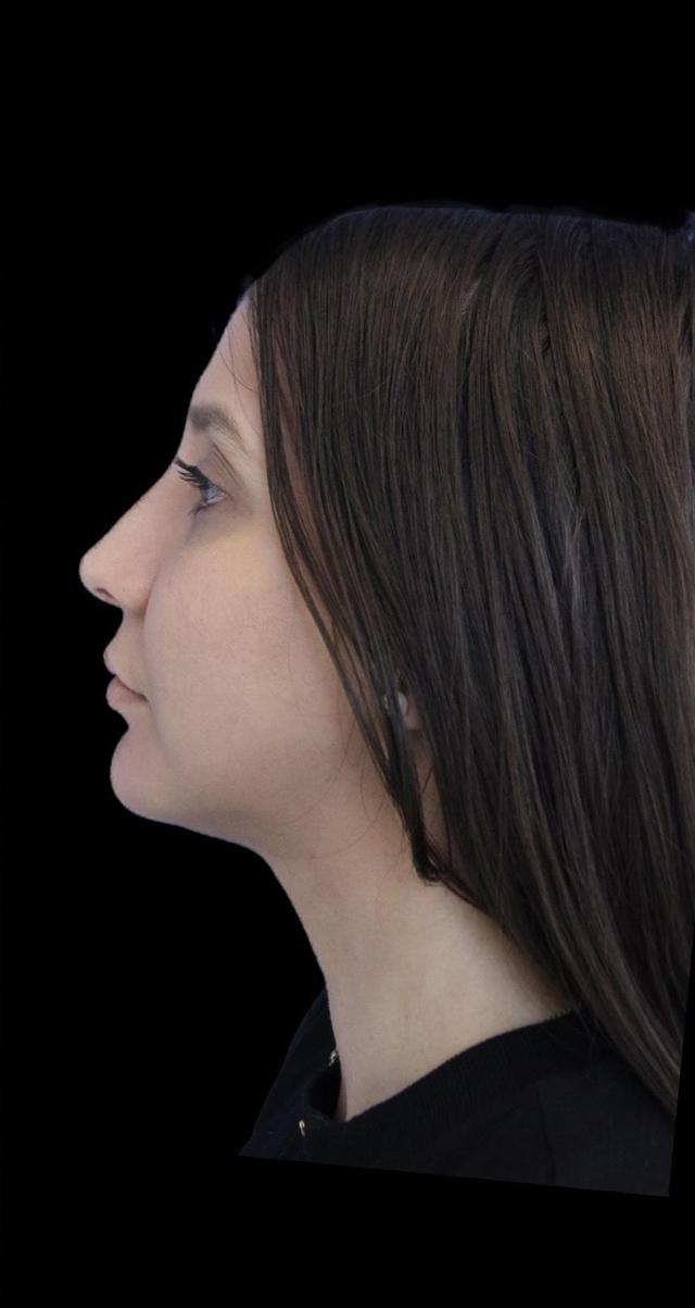 Rhinoplasty after at Aeris Plastic Surgery in Coral Gables, FL