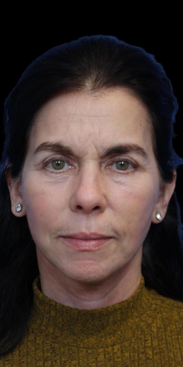 Facelift after at Aeris Plastic Surgery in Coral Gables, FL