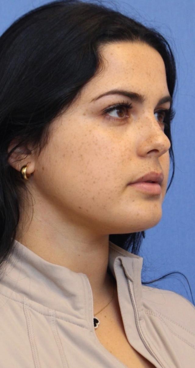 Neck Lift after at Aeris Plastic Surgery in Coral Gables, FL