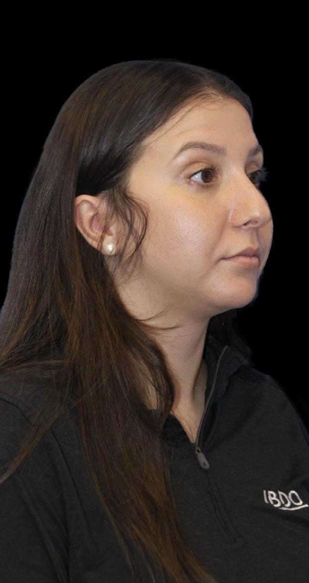 Rhinoplasty before at Aeris Plastic Surgery in Coral Gables, FL