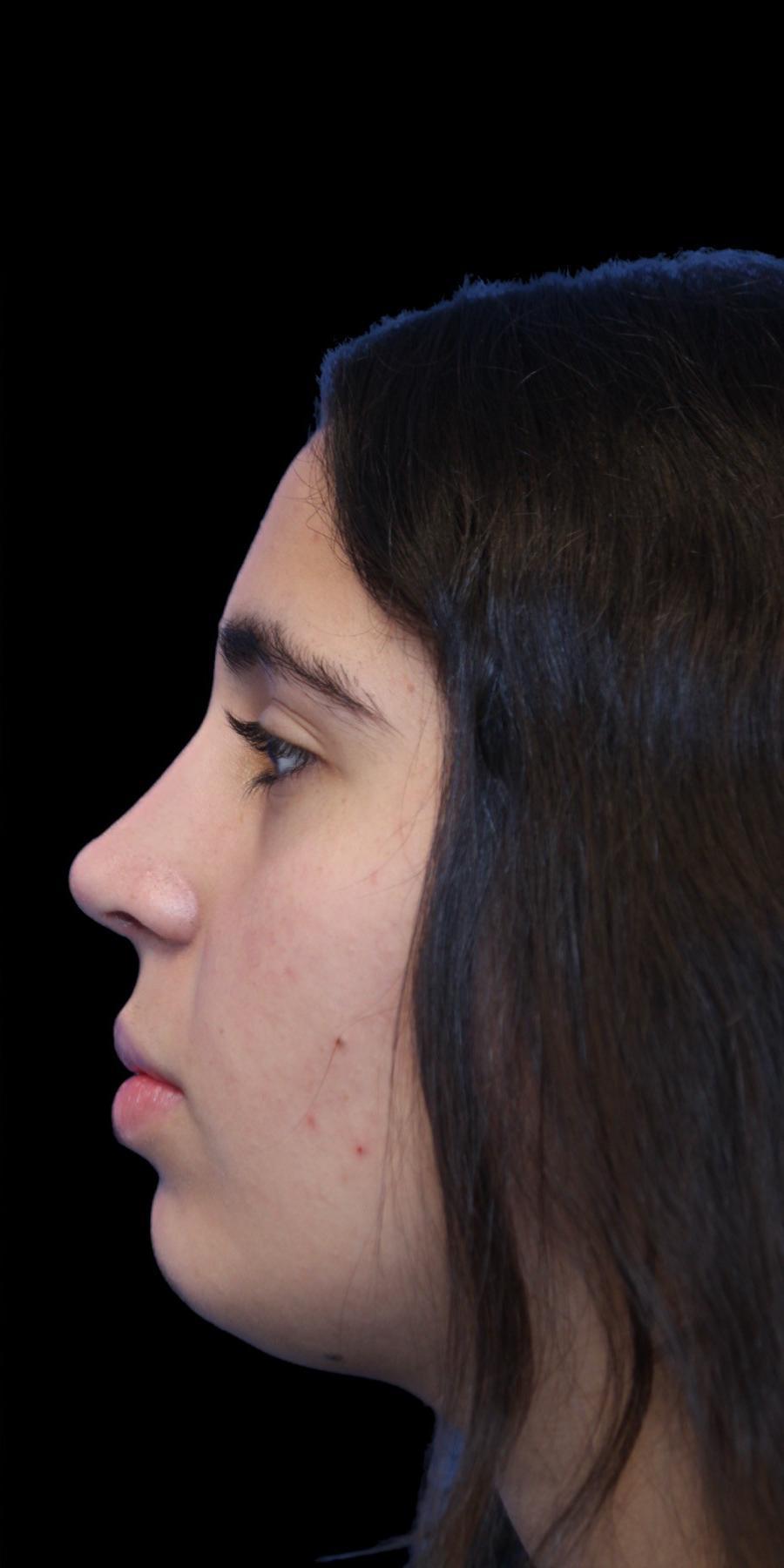 Aeris Plastic Surgery rhinoplasty after — Miami, FL