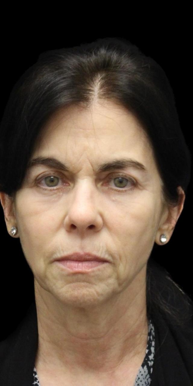 Facelift before at Aeris Plastic Surgery in Coral Gables, FL